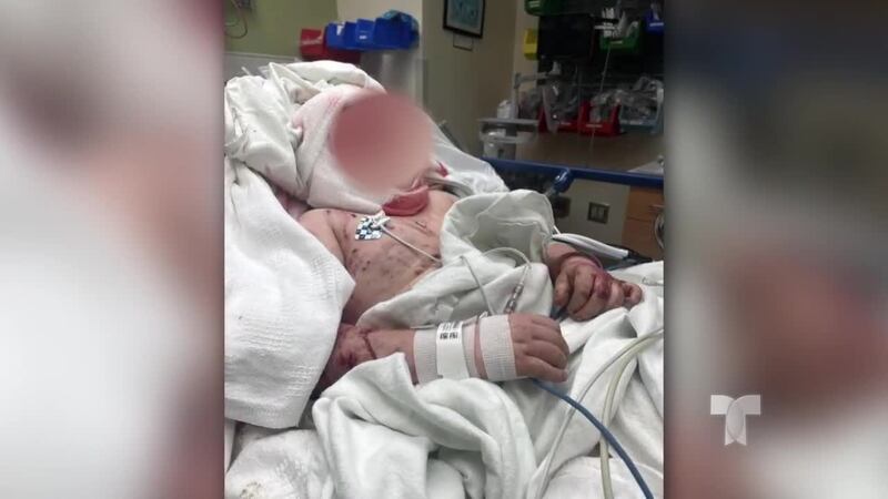 GRÁFICO: Niño de 11 años hospitalizado después de ser atacado por 3 pit bulls, dice la familia