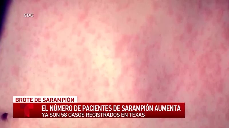 Autoridades Sanitarias emiten un aviso sobre casos sospechosos de sarampión en Dalhart